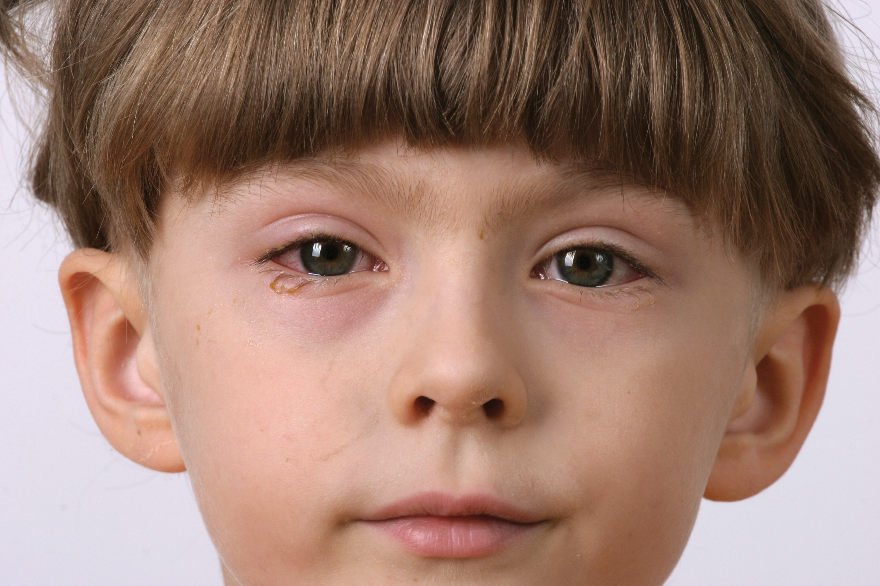 Коньюктивит у ребенка 5. Аллергический блефарит и конъюнктивит. Мешки под глазами у ребенка. Аденоидный конъюнктивит. Детские глаза.