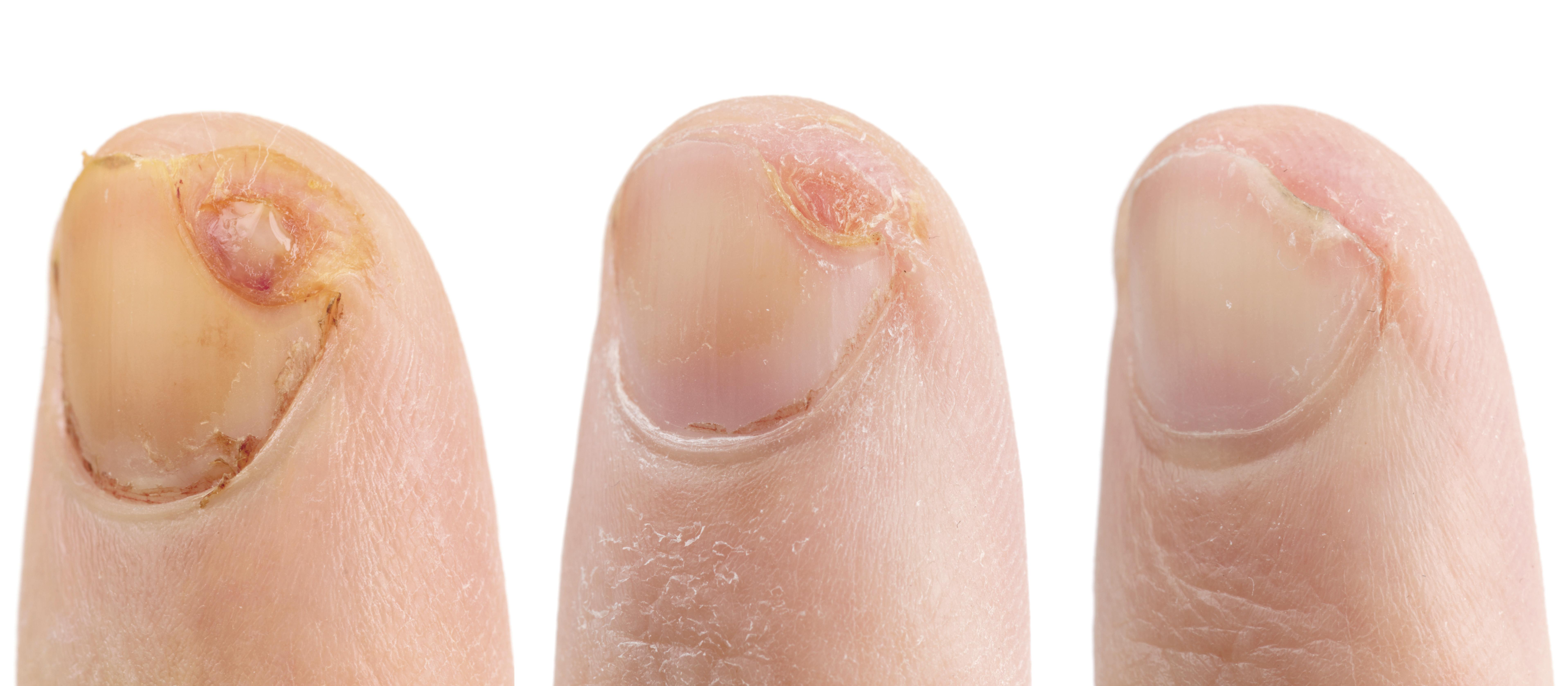 wound care fingernail