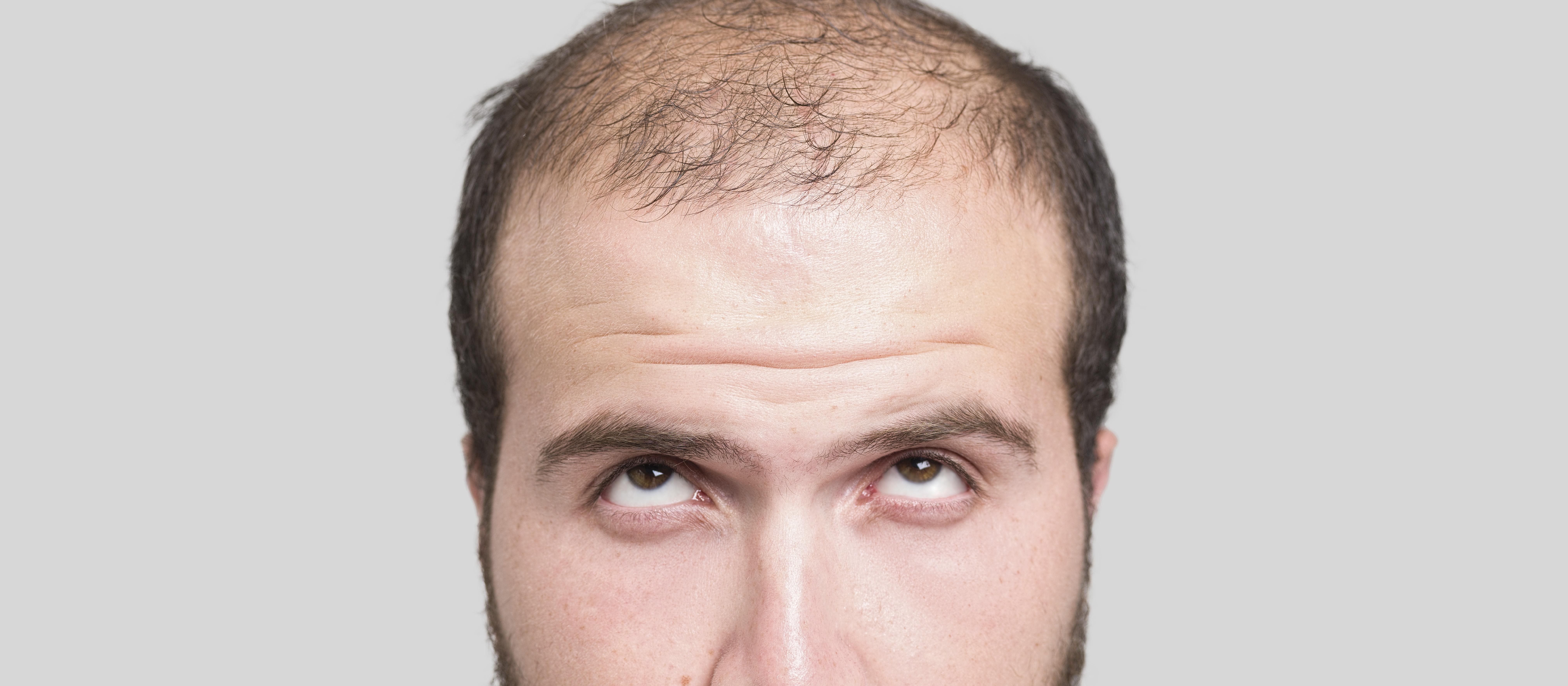 Male baldness