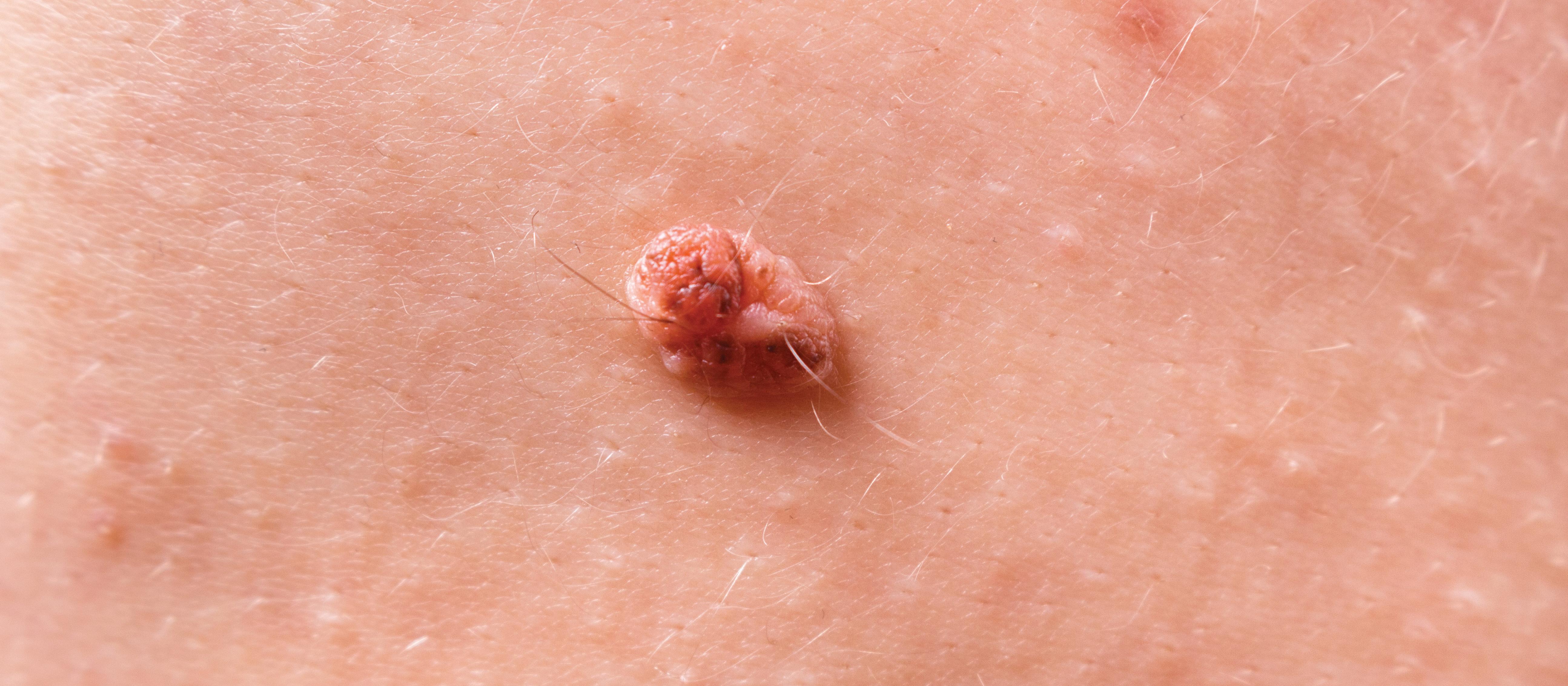 SKin tag