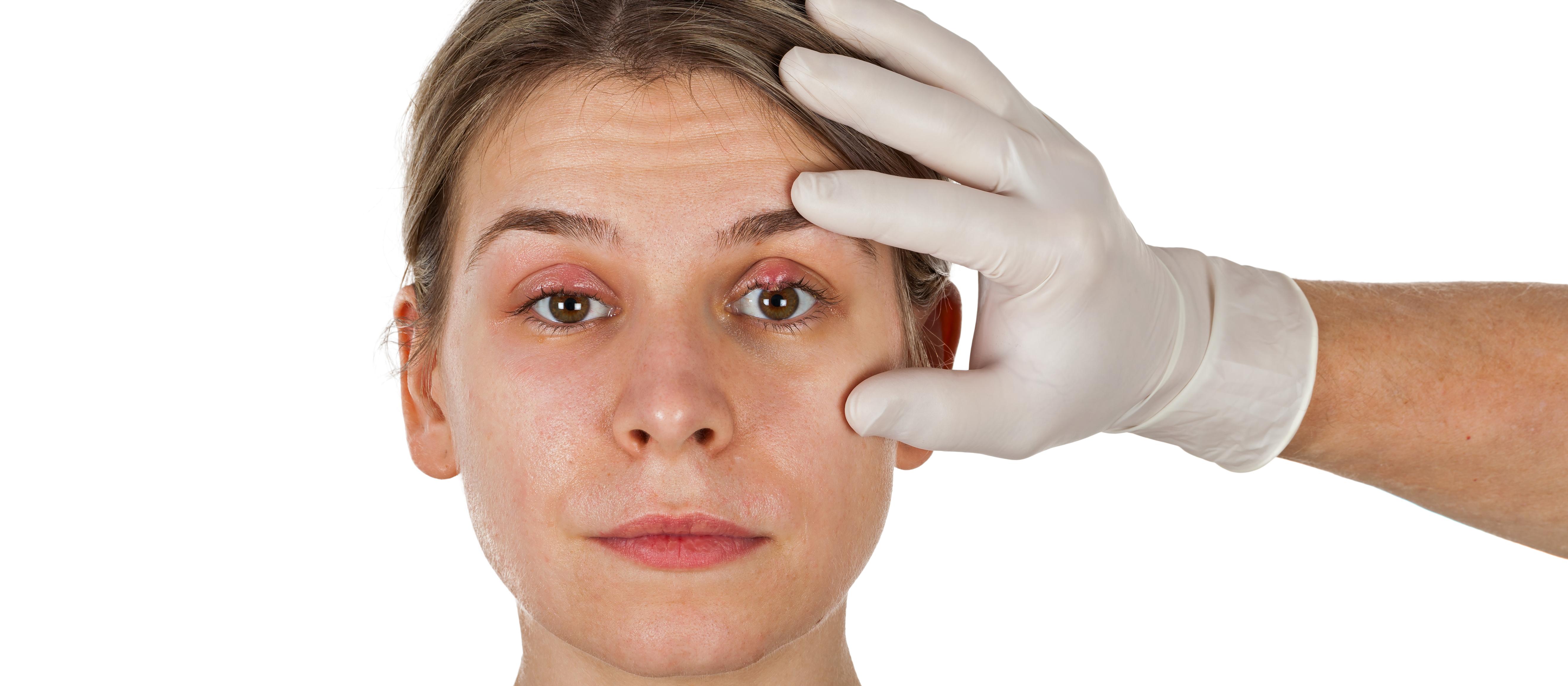 Woman with an eye infection and lump