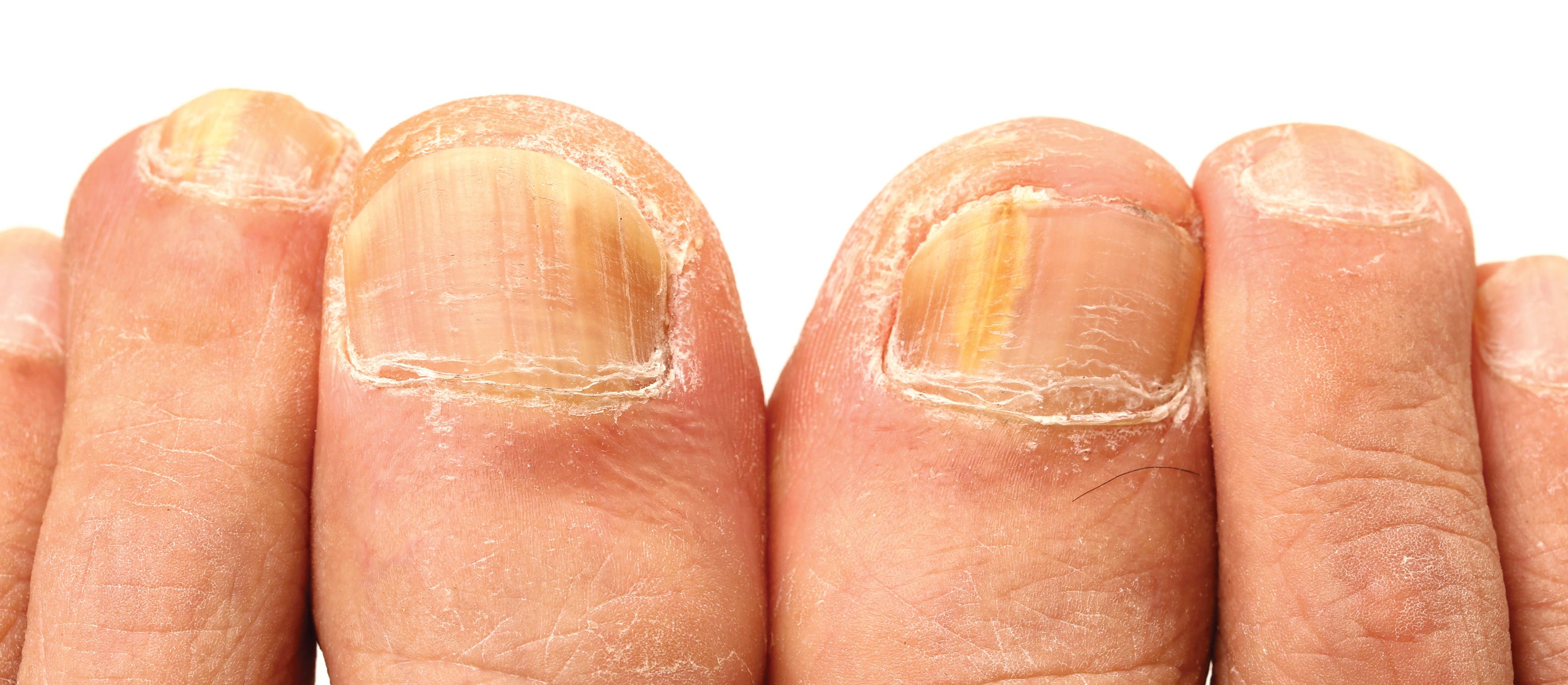 Fungal infection on nails