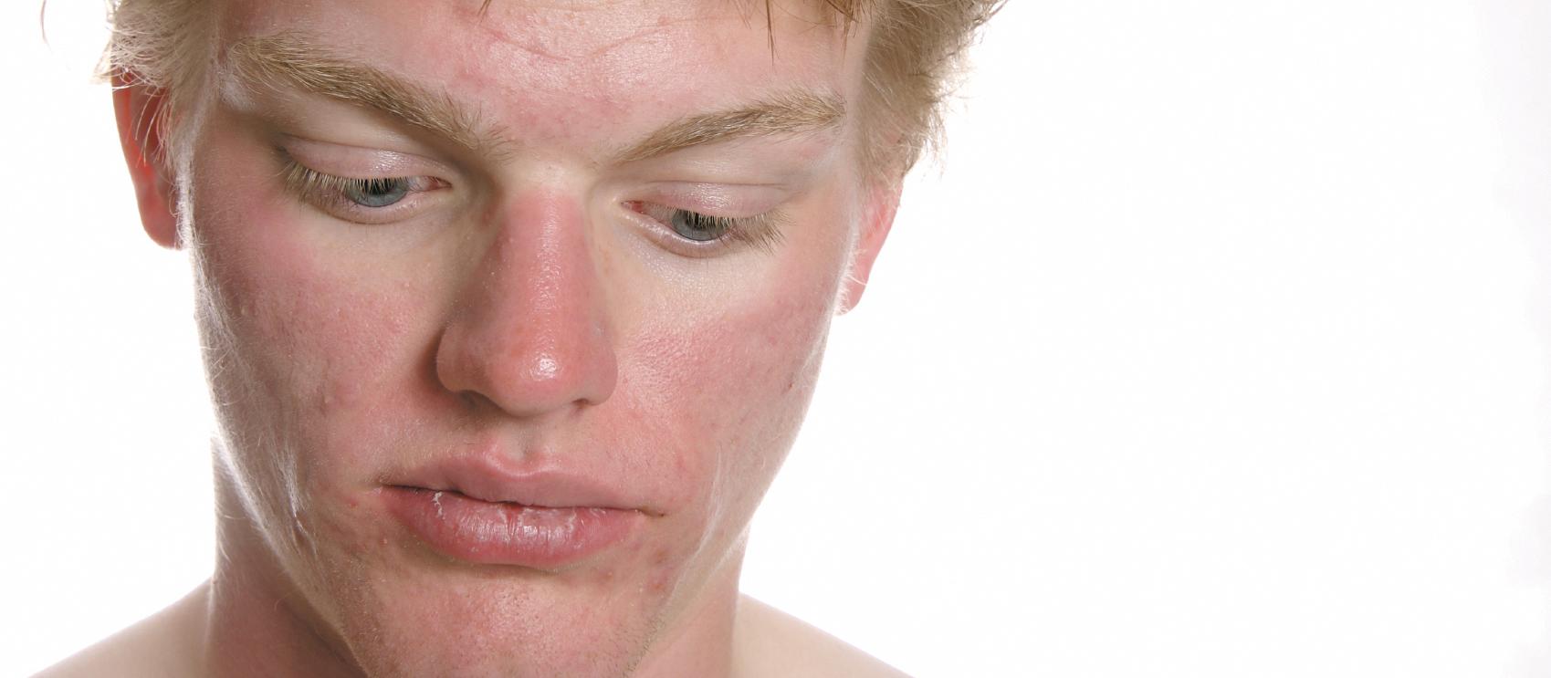 Teen boy acne