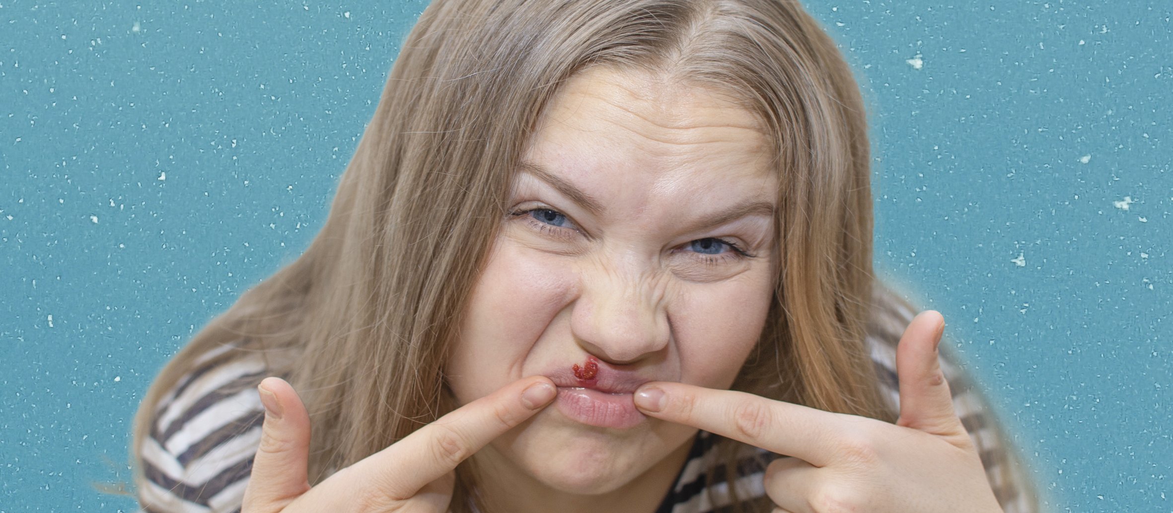 Woman cold sore