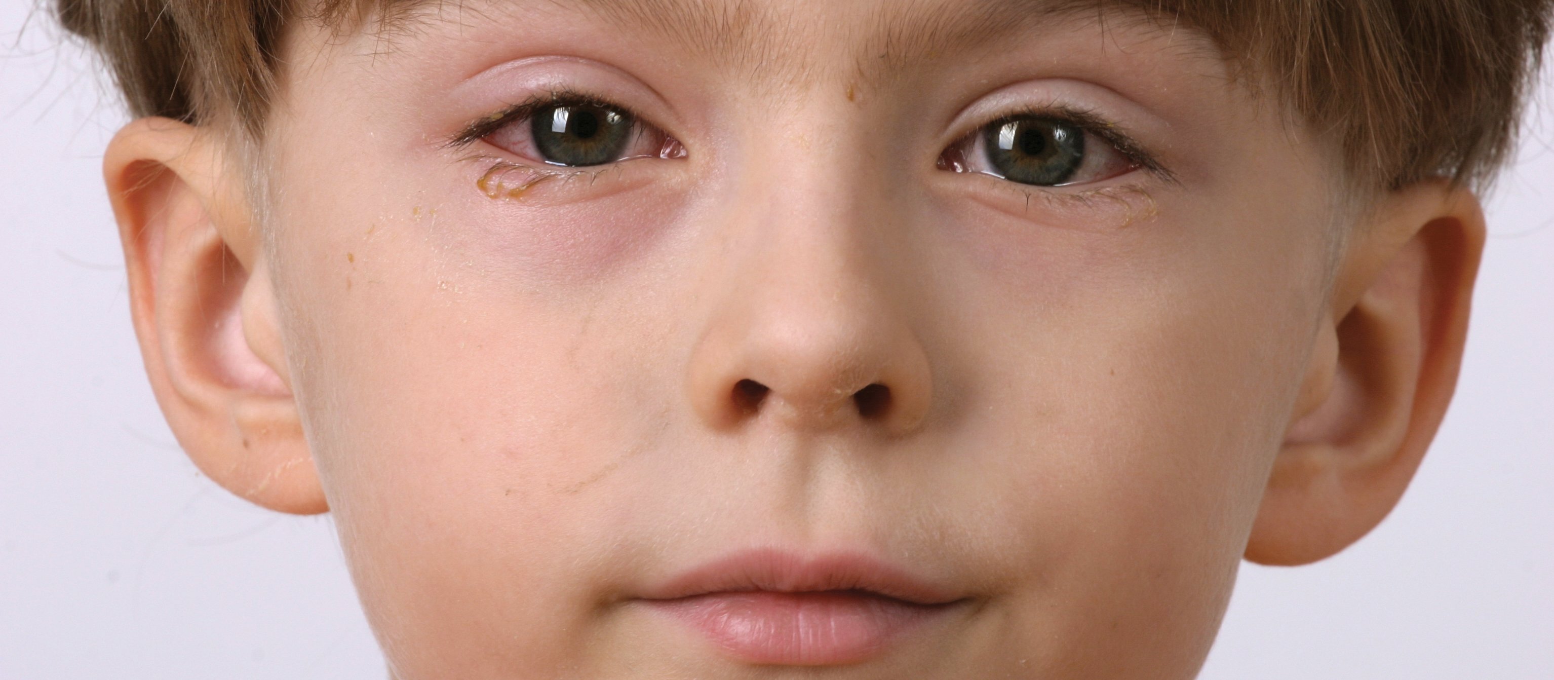 Conjunctivitus (Boy)