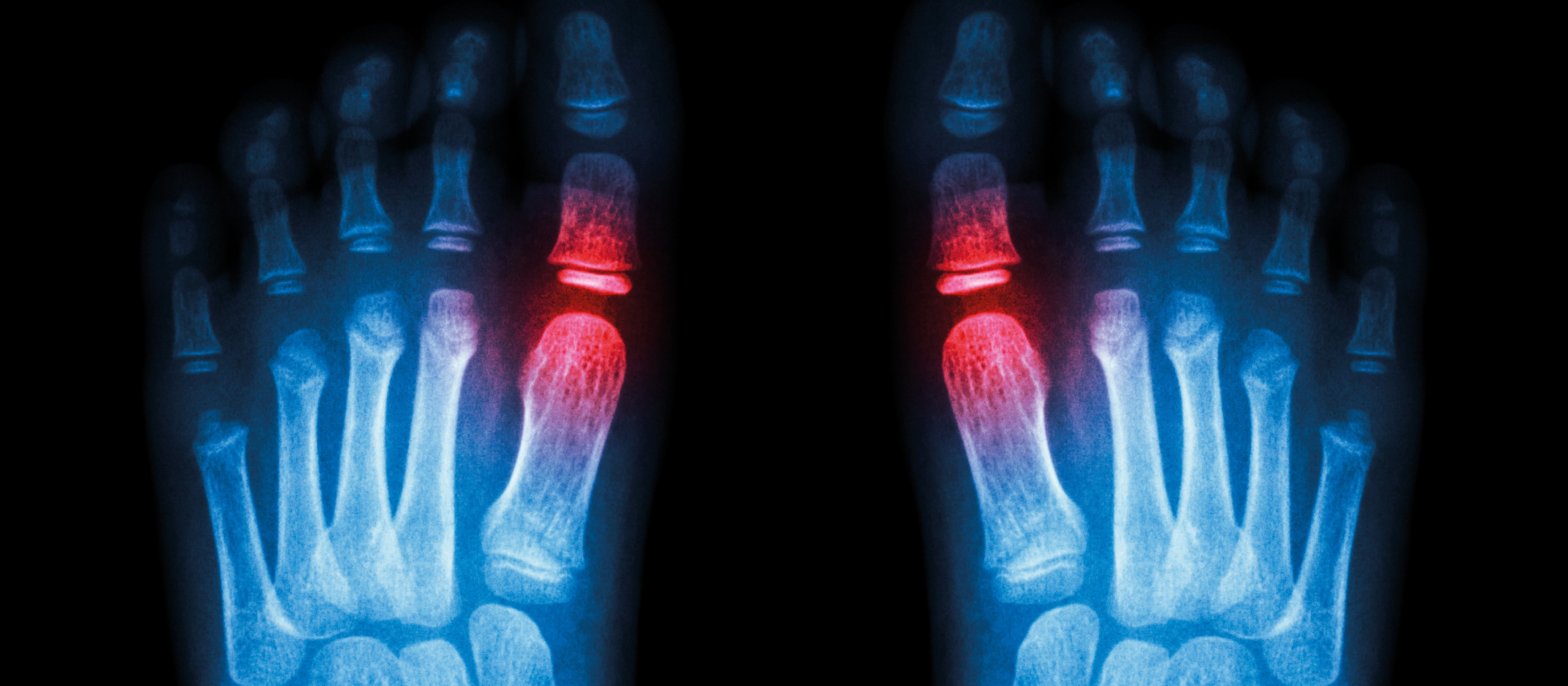 Foot x-ray (gout)
