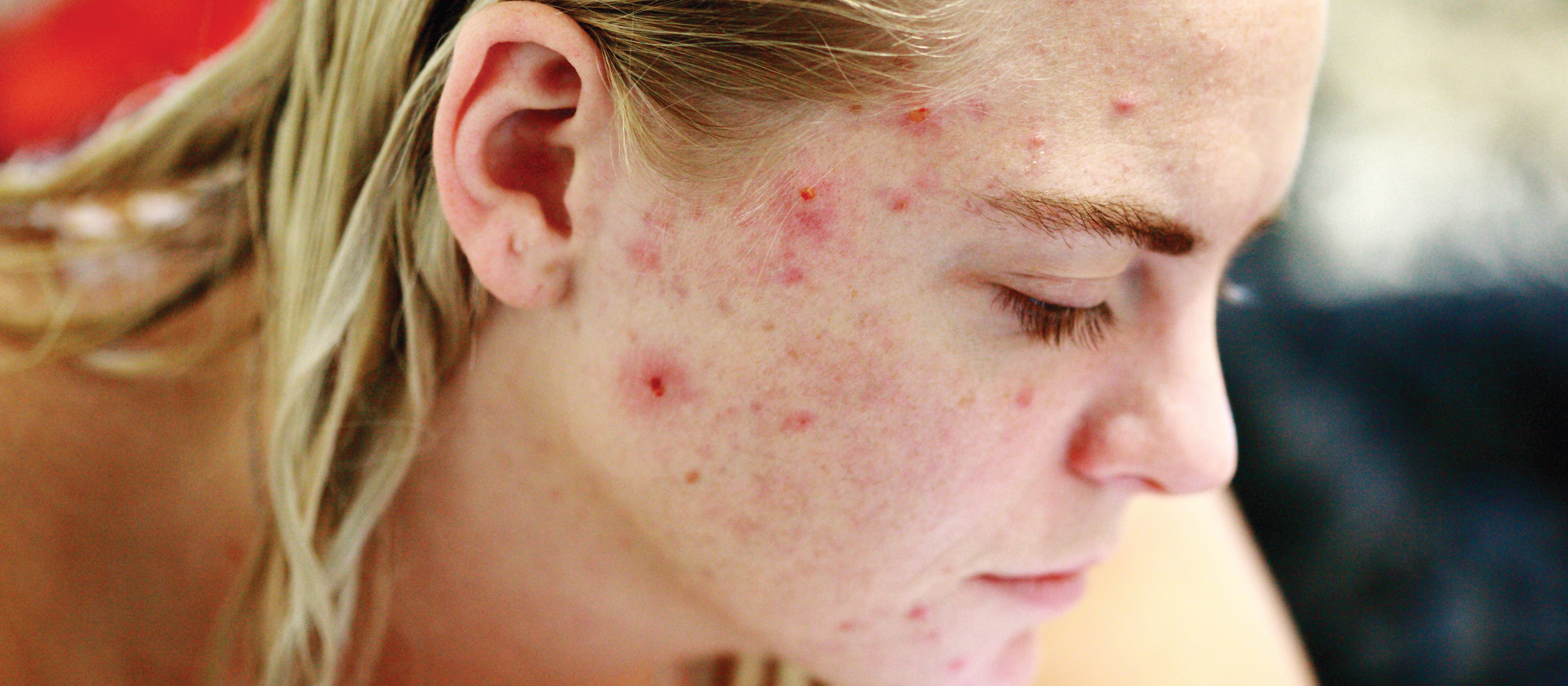 young person with acne