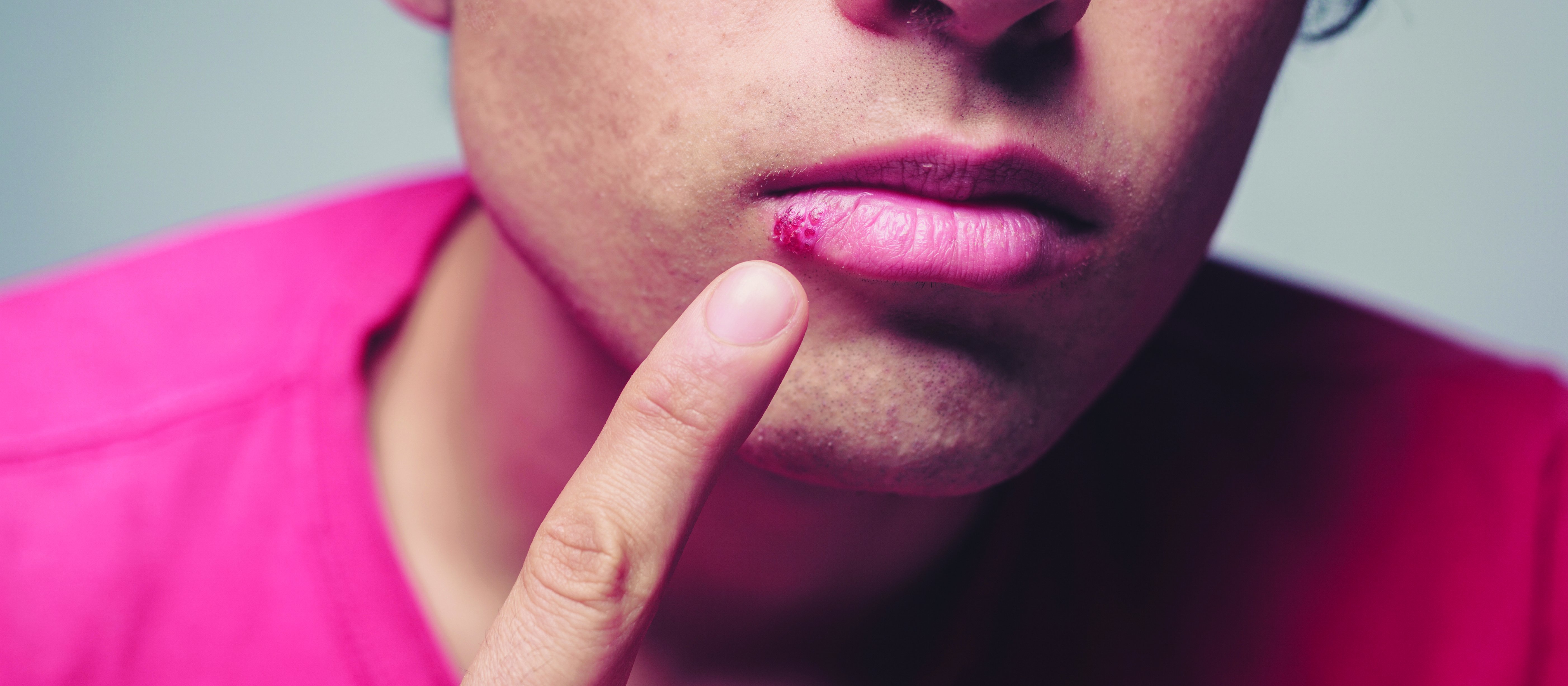 People with cold sores can infect others from the start of the tingling period until the healing of the last cold sore iStock.com – lolostock