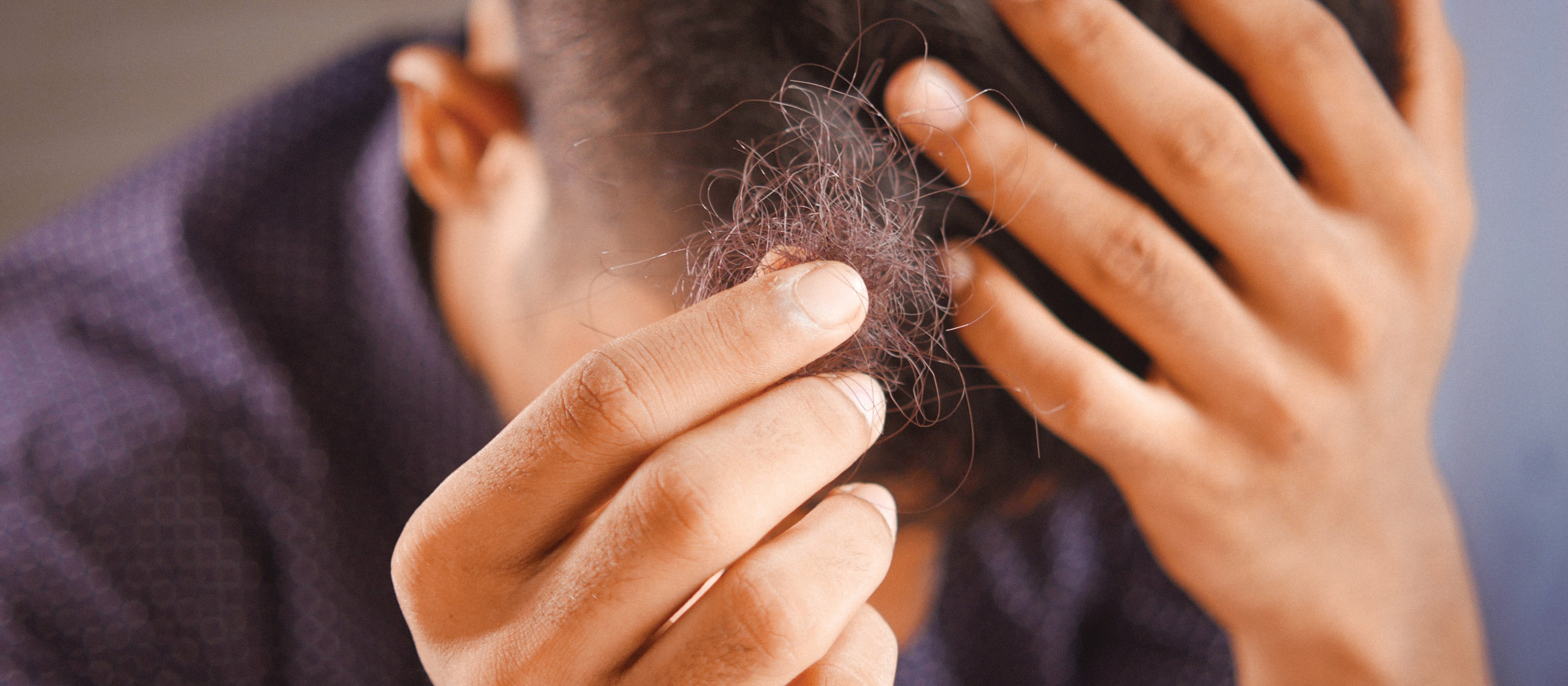 Male Baldness