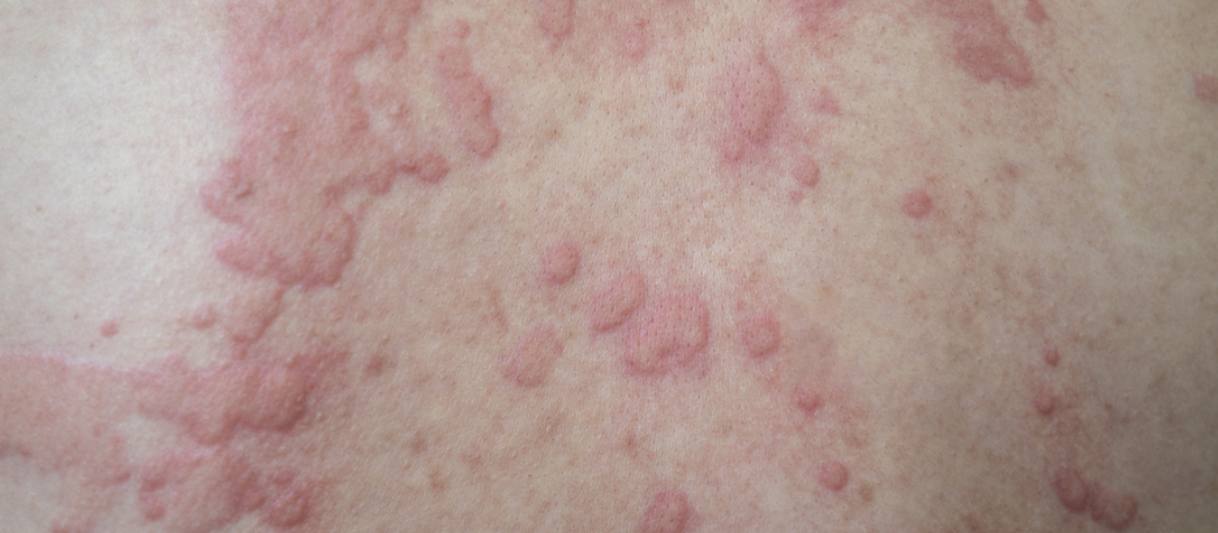 Itchy Chest: Rash, Causes, Treatment