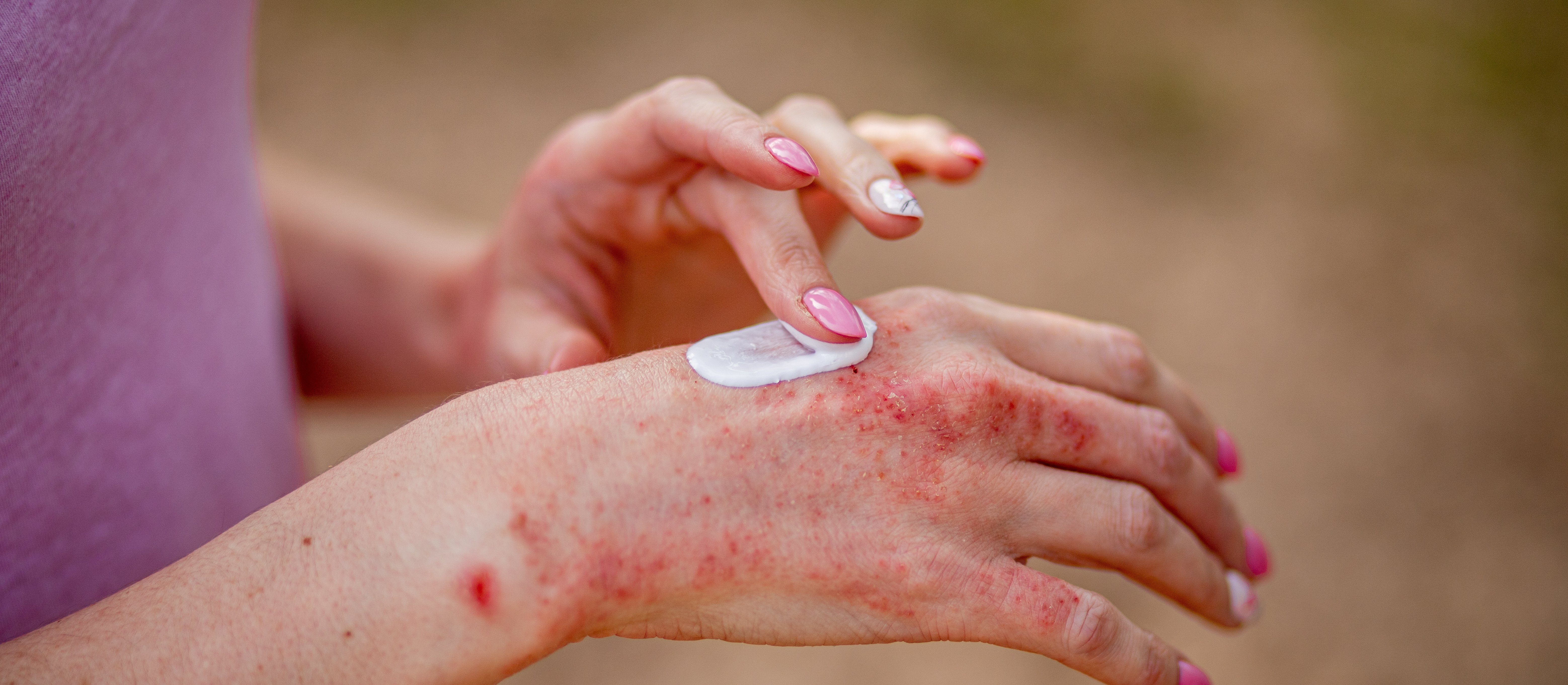 Eczema