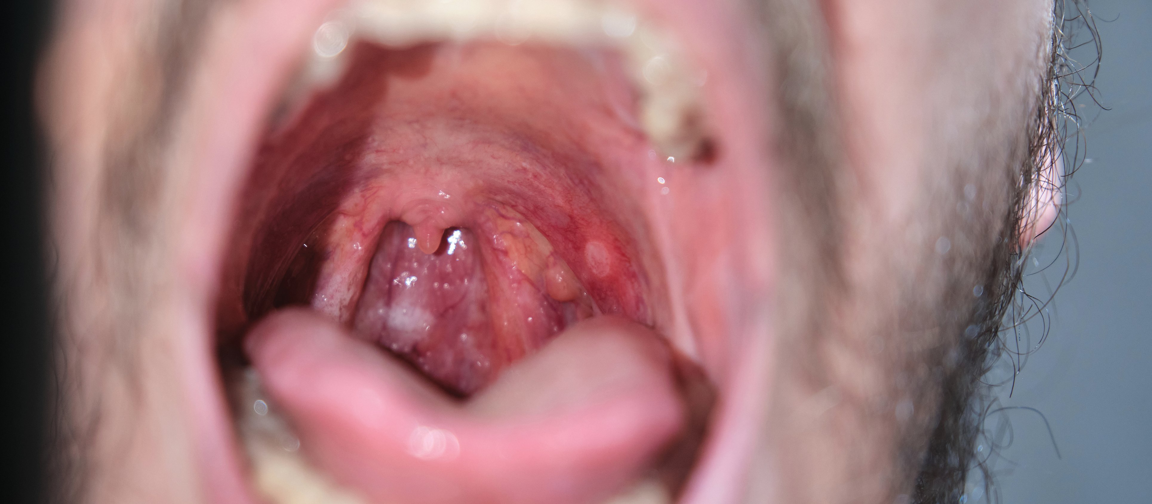 Man with ulcer in mouth