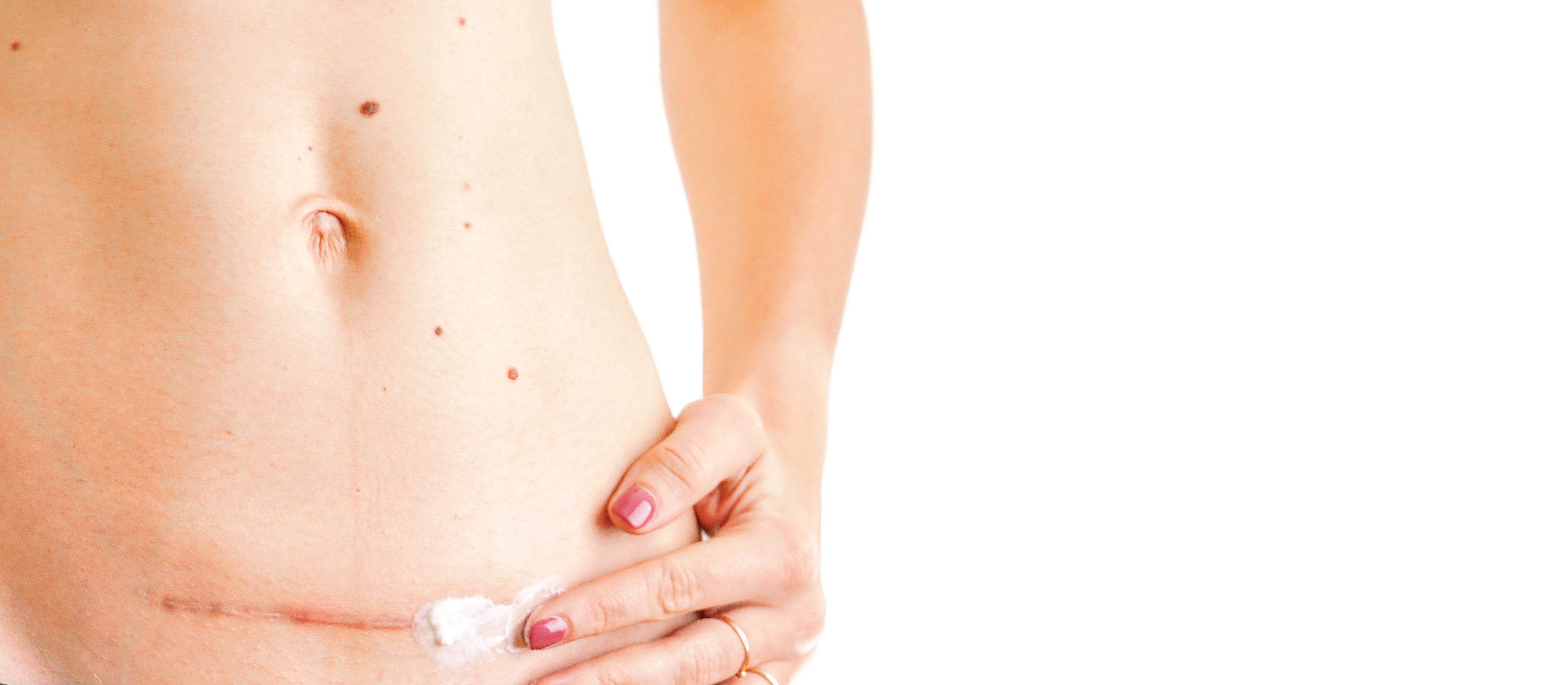 Caesarian_Scar_CR_Oleksandra Troian_on_iStock-1125135754