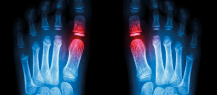 Foot x-ray CR Adobe stock