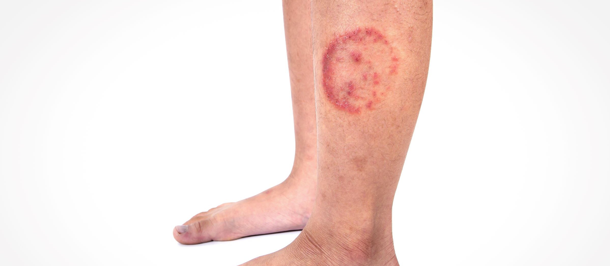 Ringworm infection Tinea corporis