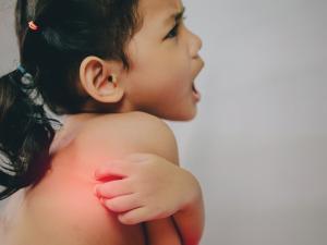 Maori pasifika child itchy eczema