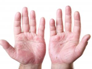 Eczema hands