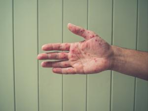 Hand with eczema