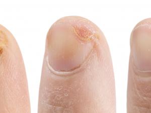 wound care fingernail