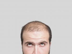 Male baldness