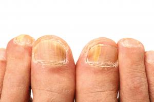 Fungal infection on nails