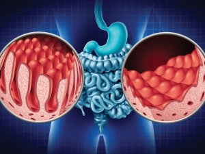 ceoliac disease - small intestine damage