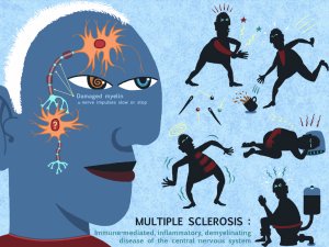HTM Multiple Sclerosis