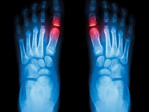 Foot x-ray (gout)