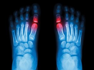 Foot x-ray (gout)