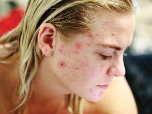 young person with acne