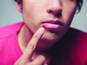  People with cold sores can infect others from the start of the tingling period until the healing of the last cold sore      iStock.com – lolostock