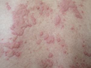 Urticaria