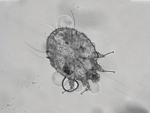 Scabies