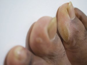 Man's toes with calluses and fungal