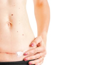 Caesarian_Scar_CR_Oleksandra Troian_on_iStock-1125135754