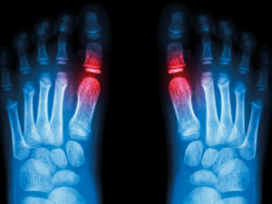 Foot x-ray CR Adobe stock