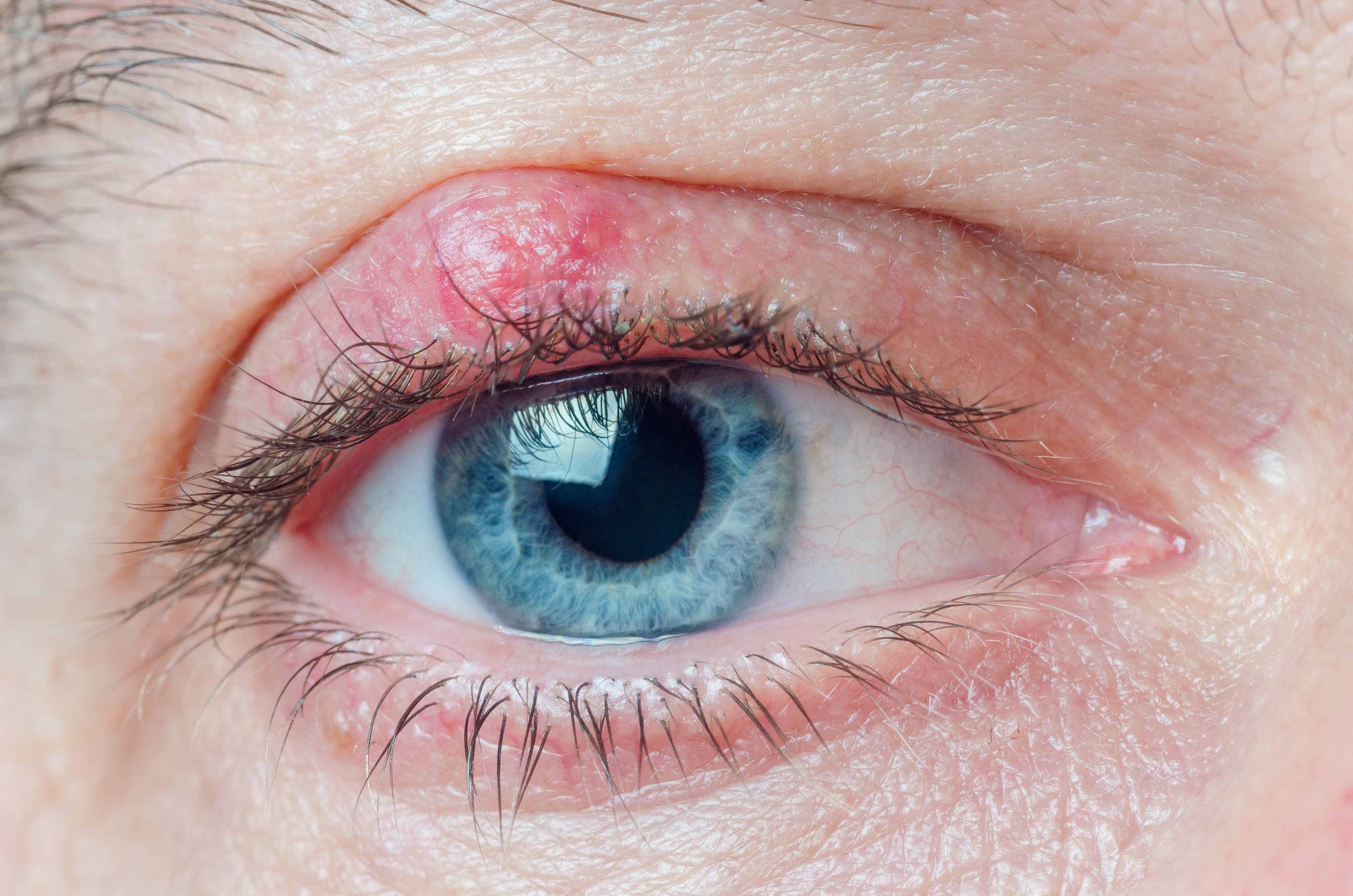 Blepharitis